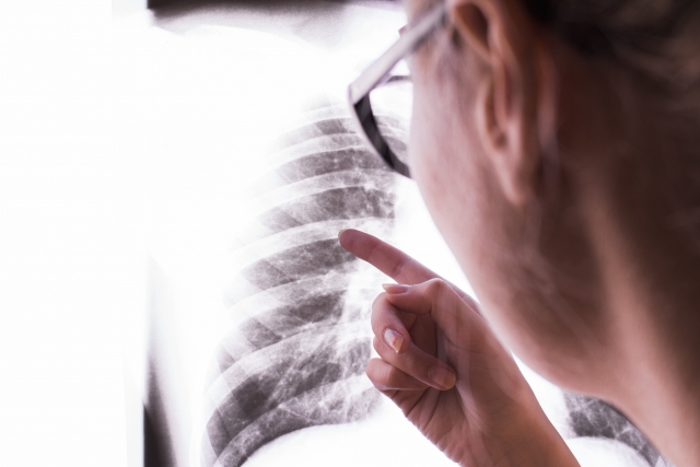 胸部レントゲン